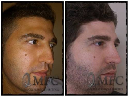 Rinoplastia